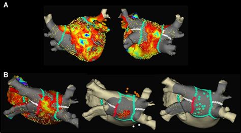 electrical posterior box isolation in repeat abation|Electrical Posterior Box Isolation in Repeat Ablation for Atrial .